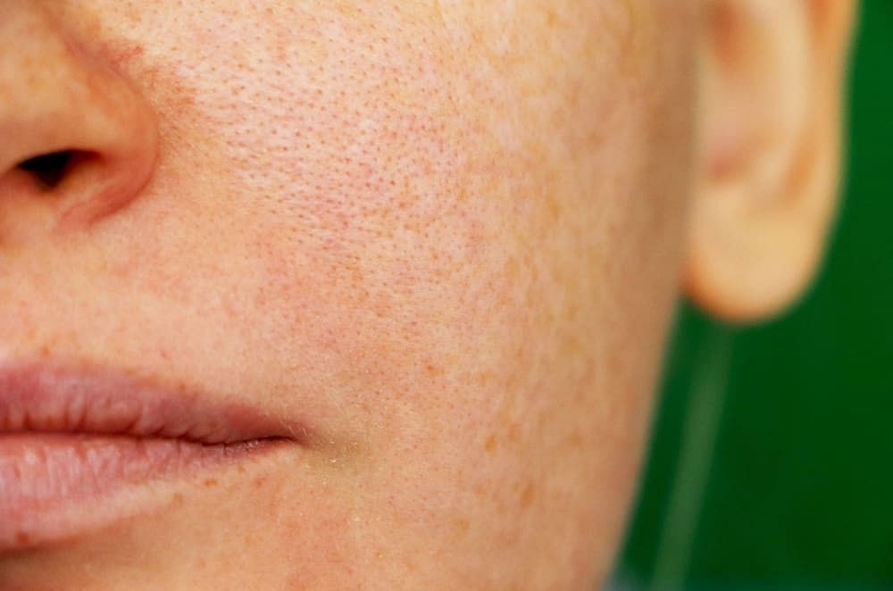 open-pores-treatment-at-home-20-ways-you-can-treat-your-open-pores